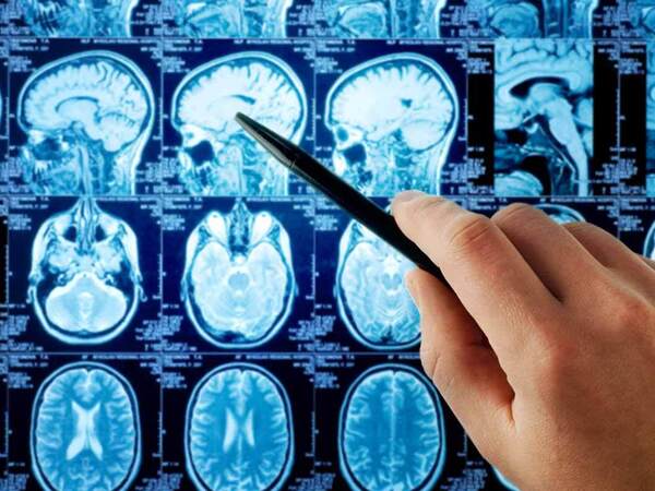 Cerebrovascular Disease